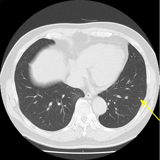 CT画像25