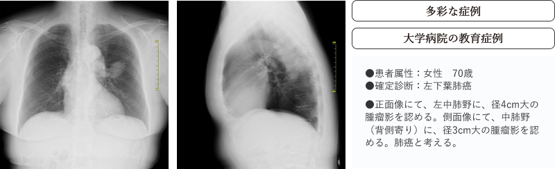 画像症例データベース　［多彩な症例］［大学病院の教育症例］●患者属性：女性　70歳　●確定診断：左下葉肺癌　●正面像にて、左中肺野に、径4cm大の腫瘤影を認める。側面像にて、中肺野（背側寄り）に、径3cm大の腫瘤影を認める。肺癌と考える。